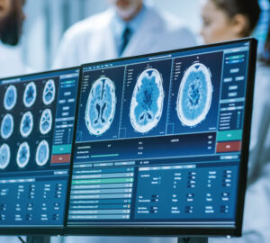 transforming dementia detection using AI